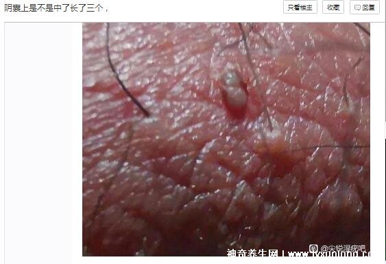 男性早期圖片尖濕銳疣長(zhǎng)在哪，生zhi器甚至是口腔(菜花狀疣體出血)
