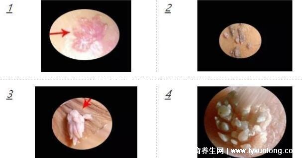 男性早期圖片尖濕銳疣長(zhǎng)在哪，生zhi器甚至是口腔(菜花狀疣體出血)