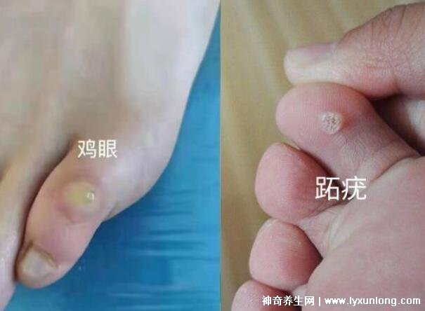男性疣是什么樣子圖片，尖銳濕疣/扁平疣/絲狀疣發病部位不同