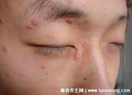 男性疣是什么樣子圖片，尖銳濕疣/扁平疣/絲狀疣發病部位不同
