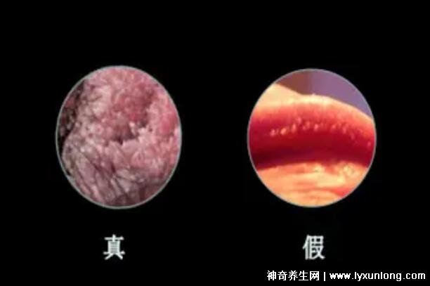 女性假疣和真疣的圖片對比，前者淡紅色和淡褐色魚子狀(5大區別)