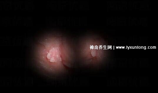 初期女士濕銳疣圖片早期，口腔尖銳濕癥狀太嚇人了(菜花樣疣體)