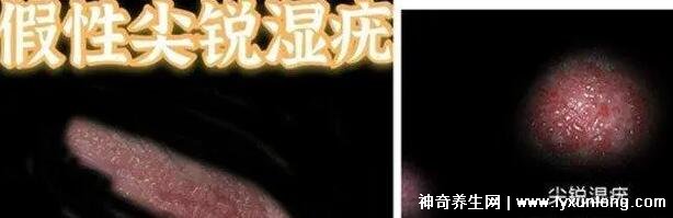 女性假疣和真疣的圖片對比，前者淡紅色和淡褐色魚子狀(5大區別)