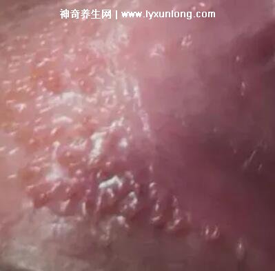 女性假疣和真疣的圖片對比，前者淡紅色和淡褐色魚子狀(5大區別)