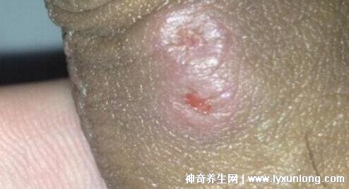男性疣是什么樣子圖片，尖銳濕疣/扁平疣/絲狀疣發病部位不同