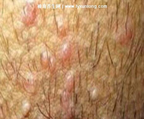 男性早期圖片尖濕銳疣長(zhǎng)在哪，生zhi器甚至是口腔(菜花狀疣體出血)