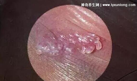 初期女士濕銳疣圖片早期，口腔尖銳濕癥狀太嚇人了(菜花樣疣體)