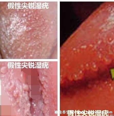 女性假疣和真疣的圖片對比，前者淡紅色和淡褐色魚子狀(5大區別)