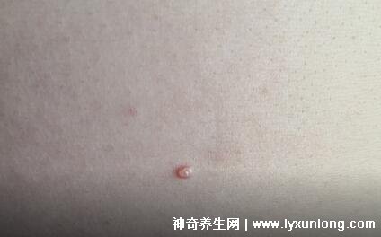 男性疣是什么樣子圖片，尖銳濕疣/扁平疣/絲狀疣發病部位不同