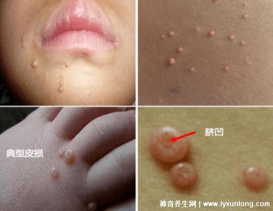 男性疣是什么樣子圖片，尖銳濕疣/扁平疣/絲狀疣發病部位不同
