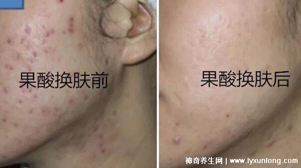 果酸換膚多少錢一次，1000-3000元不等(細致毛孔/淡化痘印)