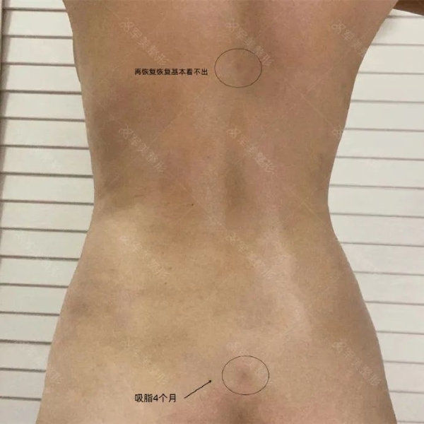 想吸脂后美美穿比基尼，這3大細(xì)節(jié)要注意