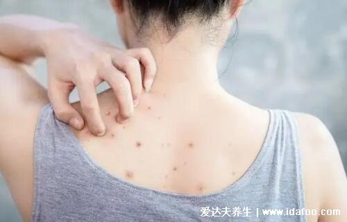 暗瘡圖片是什么樣子，暗瘡和痤瘡有區(qū)別(不形成膿包)