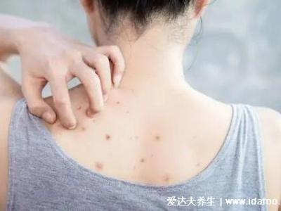 暗瘡圖片是什么樣子，暗瘡和痤瘡有區(qū)別(不形成膿包)