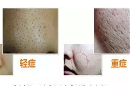 肌膚毛孔空隙的三種不同類型，女性都想了解的護膚小知識