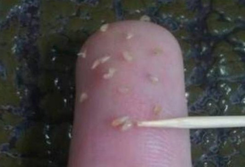 鼻子上擠出來的白色東西是什么？如何正確去除