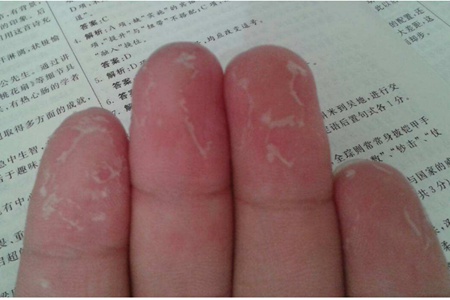 手指脫皮的四個(gè)原因，教你快速恢復(fù)方法治療手脫皮