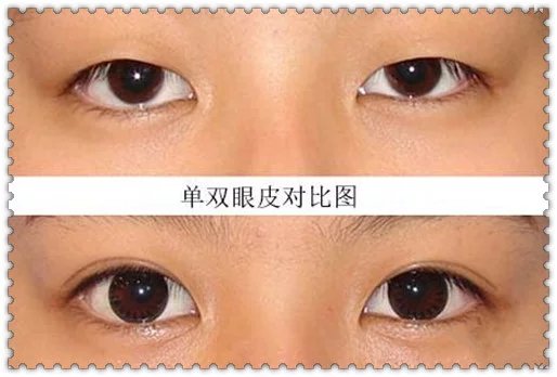雙眼皮貼久了有害嗎？一天貼多久最適宜？
