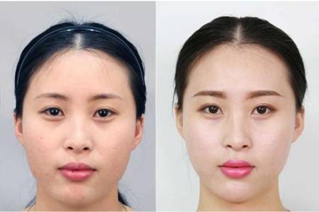 打一次瘦臉針的費用，女生注射瘦臉要知道三個危害