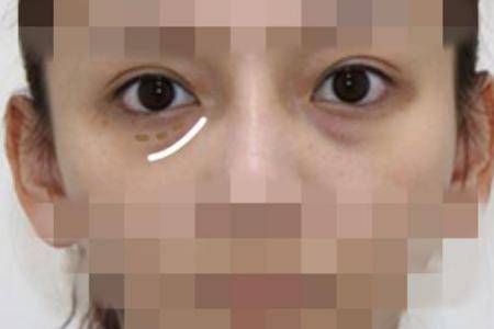 怎樣祛眼袋,讓眼袋消失無蹤的有效妙招-易網(wǎng)健康<a href=http://m.aoa7937.com/jkys/ target=_blank class=infotextkey>養(yǎng)生</a>網(wǎng) 怎樣祛眼袋,讓眼袋消失無蹤的有效妙招