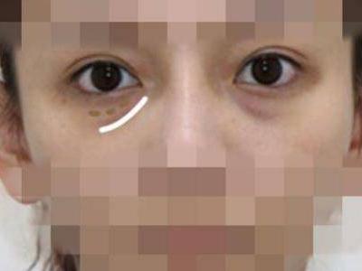 怎樣祛眼袋，讓眼袋消失無蹤的有效妙招
