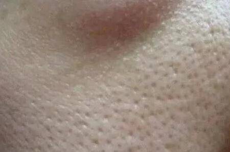 毛孔粗大怎么辦 針對不同情況的毛孔粗大該如何護膚?-易網健康<a href=http://m.aoa7937.com/jkys/ target=_blank class=infotextkey>養生</a>網 毛孔粗大怎么辦 針對不同情況的毛孔粗大該如何護膚?