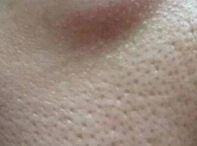 毛孔粗大怎么辦 針對不同情況的毛孔粗大該如何護膚？