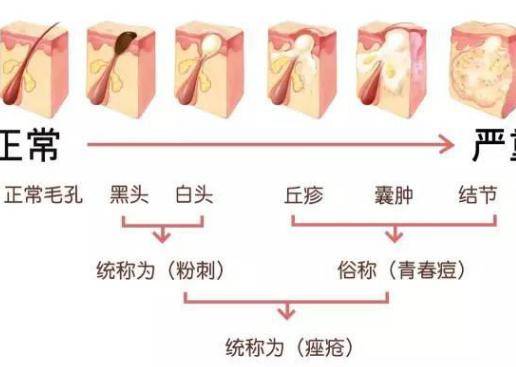 臉上長(zhǎng)痘痘怎么調(diào)理?做好這三點(diǎn)讓痘痘遠(yuǎn)離你-易網(wǎng)健康<a href=http://m.aoa7937.com/jkys/ target=_blank class=infotextkey>養(yǎng)生</a>網(wǎng) 臉上長(zhǎng)痘痘怎么調(diào)理?做好這三點(diǎn)讓痘痘遠(yuǎn)離你