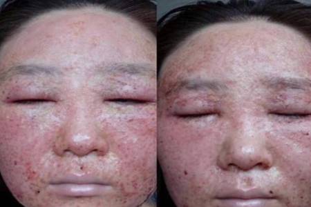 激素臉初期癥狀圖片大全 嚴(yán)重的激素臉紅癢用什么去除