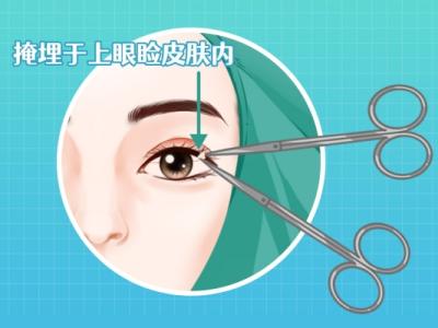 雙眼皮做手術(shù)一般價(jià)錢