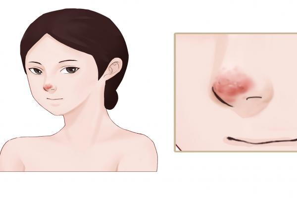 草莓鼻子怎么去掉還能縮小毛孔