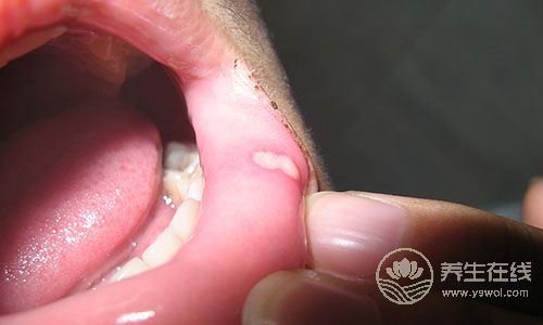 夏天口腔潰瘍怎么辦?5種水果助你排毒治病 夏天口腔潰瘍怎么辦?5種水果助你排毒治病