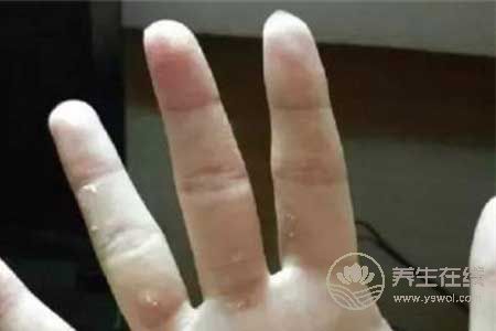 冬季手上有凍瘡怎么治