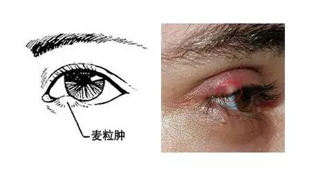 孩子長針眼怎么辦？