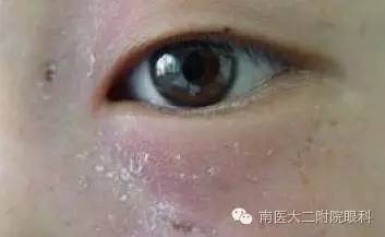 兒童兒淚囊炎的三種發病原因