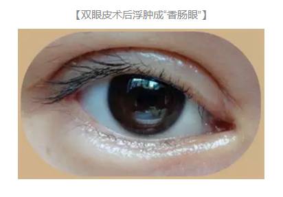 雙眼皮術(shù)后出現(xiàn)上瞼下垂怎么辦？