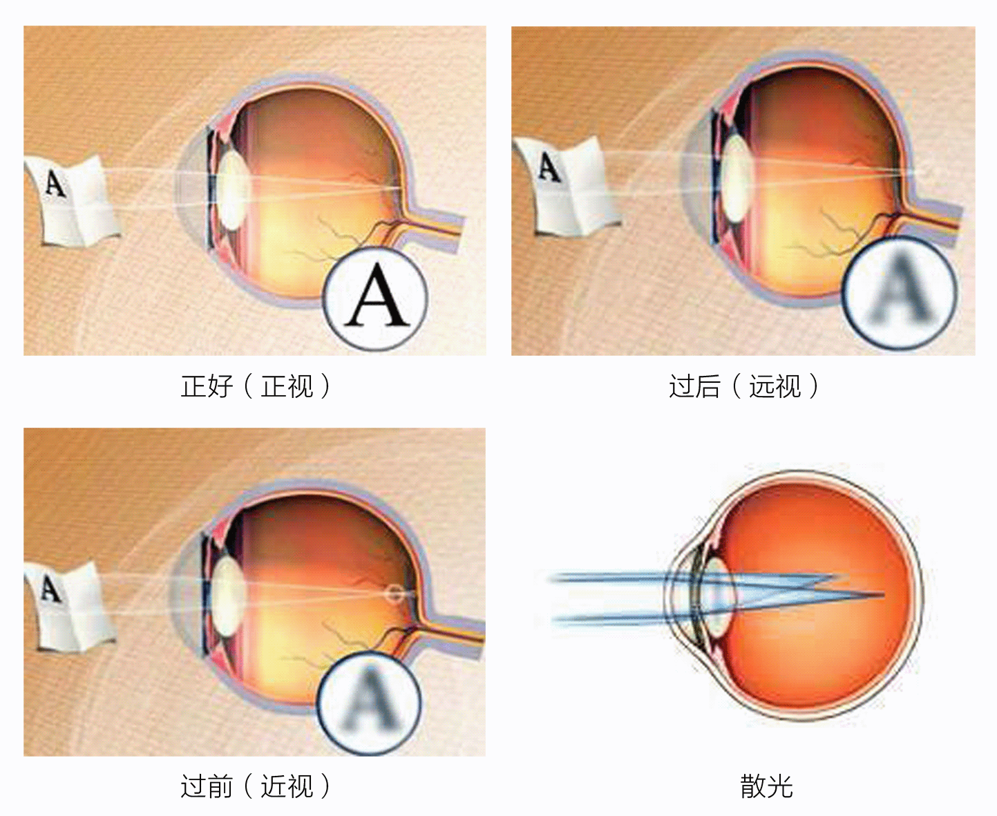 屈光不正是什么意思？