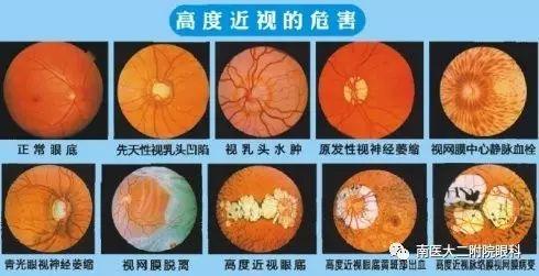高度<a href=http://m.aoa7937.com/tags-近視.html target=_blank class=infotextkey>近視</a>患者注意六大事項 高度近視患者注意六大事項