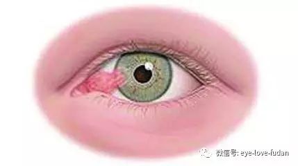人眼為什么會長“多肉”？