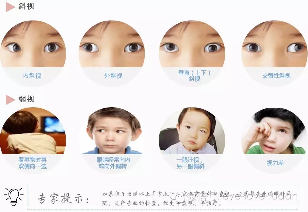 孩子斜弱視治療,不要錯過關(guān)鍵時(shí)機(jī) 孩子斜弱視治療,不要錯過關(guān)鍵時(shí)機(jī)