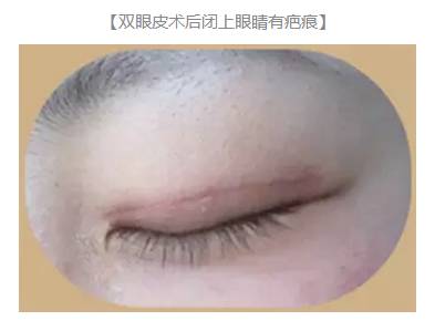 雙眼皮術(shù)后出現(xiàn)上瞼下垂怎么辦？