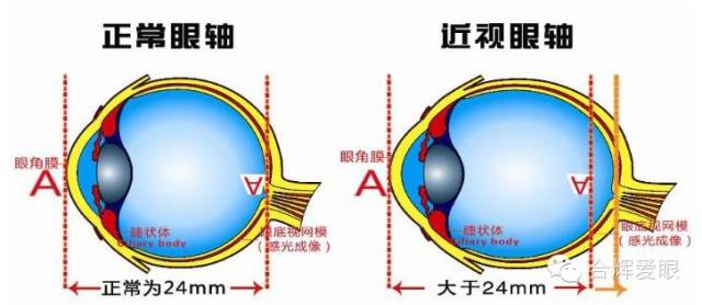 眼鏡戴久了，眼睛會變形嗎？