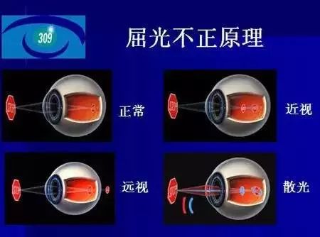 弱視是怎么形成的？它與近視有哪些區別？