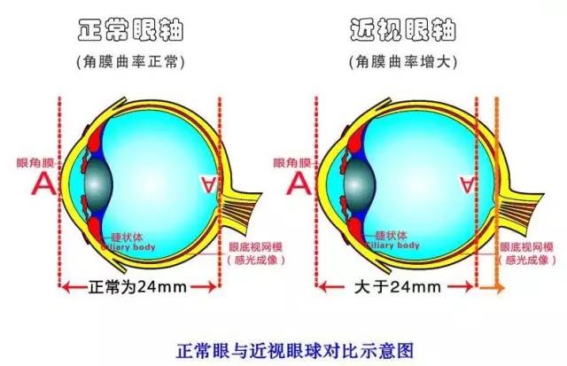 孩子近視度數猛漲？近視防控小心誤區！