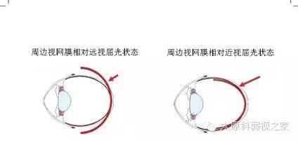 兒童近視防控中更應(yīng)重視離焦問題
