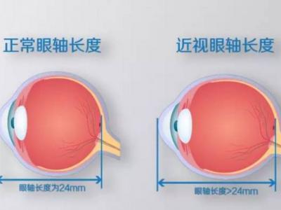 近視不可怕，度數(shù)越來越深才可怕