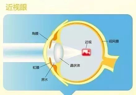 近視的原因、預(yù)防與治療