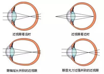 適齡兒童不論視力好壞都應該驗光