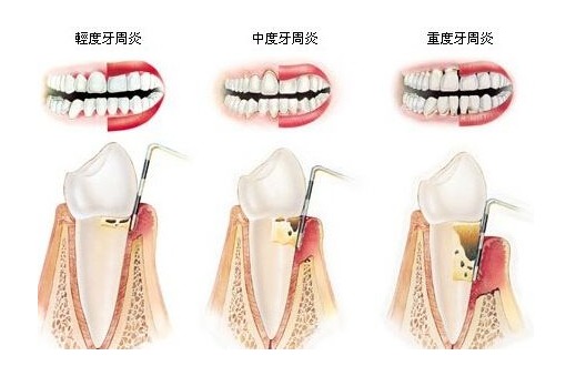 為什么會有牙周?。垦乐懿〉闹嗅t治療和保養方法