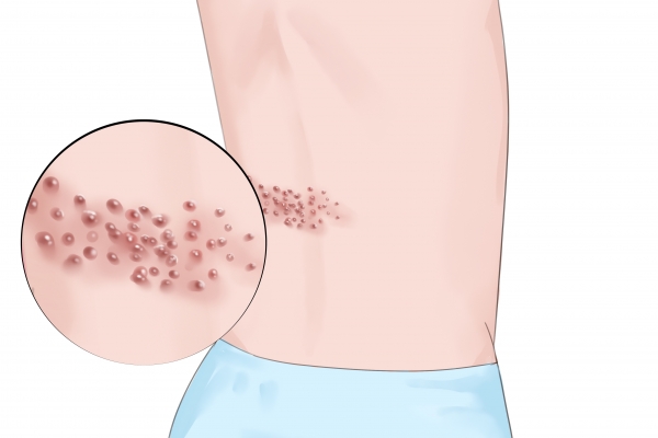 褥瘡外用藥有哪些